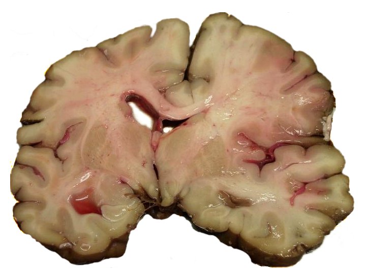 MCA-Stroke-Brain-Human-2
